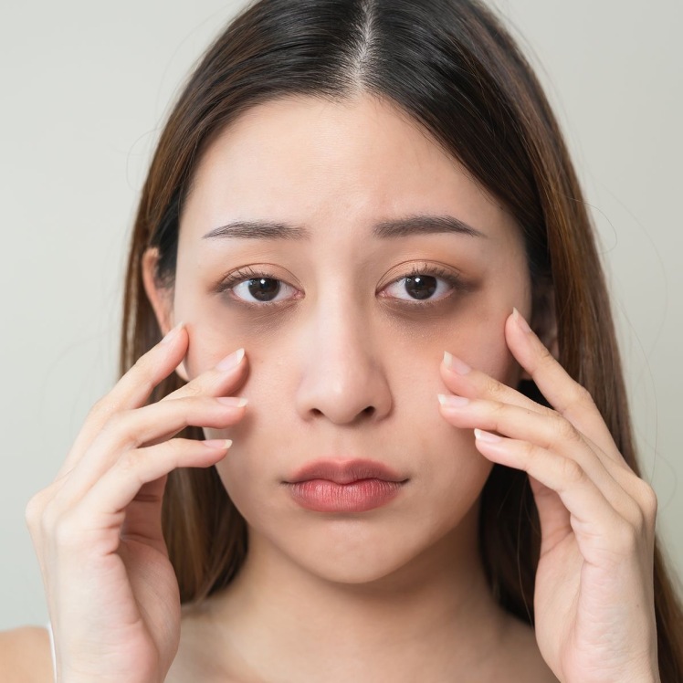 ارتباط کمبود آهن و کم خونی با سیاهی دور چشم چیست؟