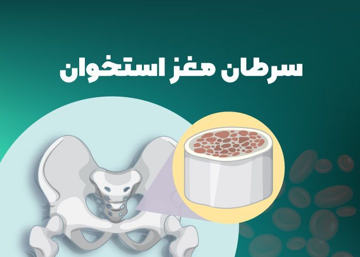 علائم سرطان استخوان که نباید نادیده بگیرید