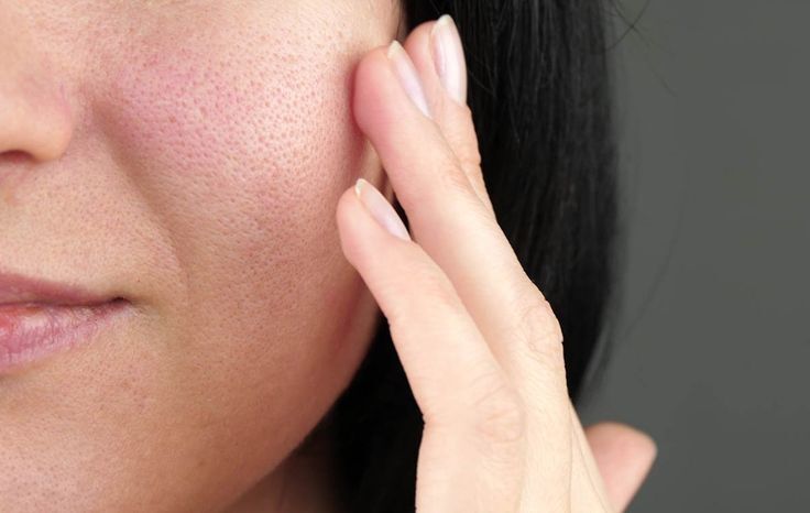  علت باز شدن منافذ پوست و راه‌هایی برای کاهش آن