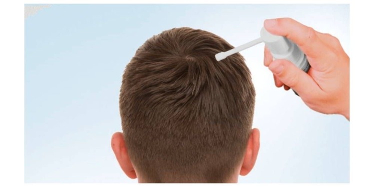 ماینوکسیدیل 5 درصد مناسب چه کسانی است؟نحوه استفاده از ماینوکسیدیل