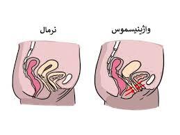  واژینیسموس چیست ؟علل ایجاد واژینیسموس روش‌های درمانی واژینیسموس